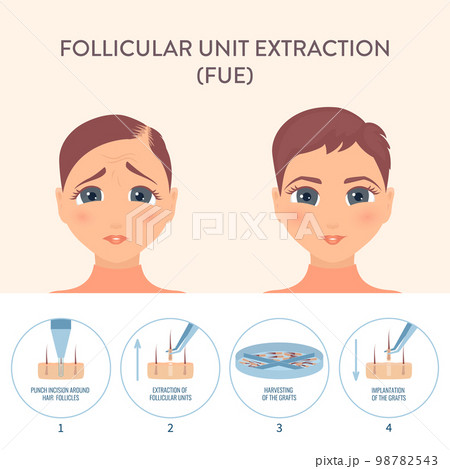 Female hair transplantation procedure medical infographic poster 98782543