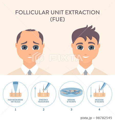 Hair transplantation procedure in men medical infographic poster Hair transplantation procedure in men medical infographic poster 98782545