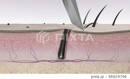 Hair shaving with bad results. A razor blade cuts body hair. 3D rendered illustration that shows the imperfection of hair removal by a razor blade 98829706