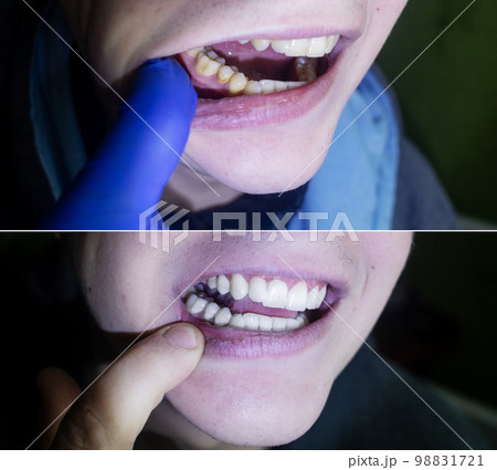 Tartar removal. Before and after the procedure for cleaning the tooth enamel from plaque and yellowness. Deposition of microbial life products on the roots of the tooth. Tartar removal. Before and after the procedure for cleaning the tooth enamel from plaque and yellowness. Deposition of microbial life products on the roots of the tooth. 98831721