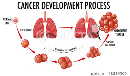 Diagram showing cancer development process 98839500