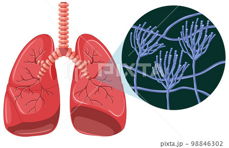 The mold spores grow in human lungs 98846302