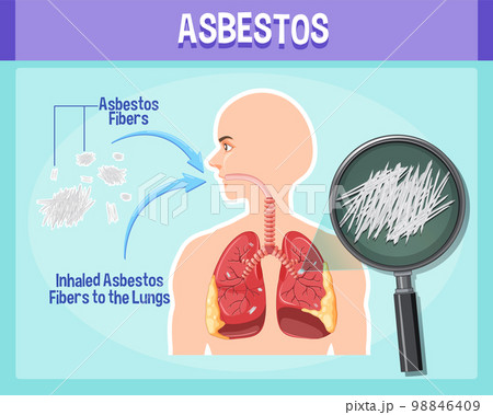 Diagram showing asbestosis in lungs 98846409