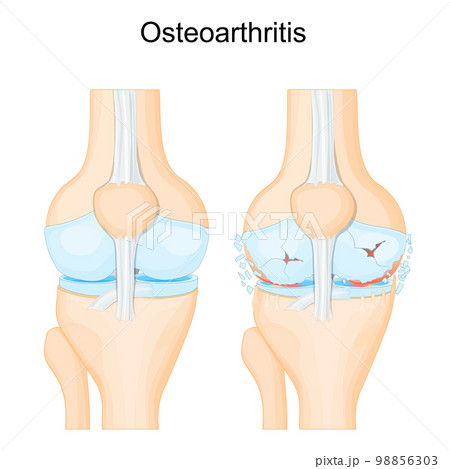 Knee osteoarthritis. degenerative joint disease 98856303