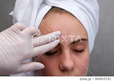Acne. Teenage girl with the pimples on her face. Problematic skin. Acne. Teenage girl with the pimples on her face. Problematic skin. 98864592