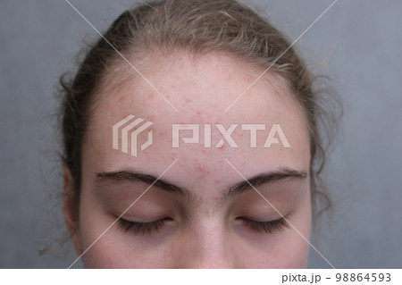 Acne. Teenage girl with the pimples on her face. Problematic skin. Close-up. Acne. Teenage girl with the pimples on her face. Problematic skin. Close-up. 98864593