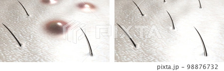 Ingrown hairs and follicle inflammation. Problem skin before and after effective treatment. 3D render 98876732