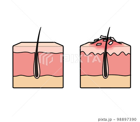 乾癬(図解)文字なし 乾癬(図解)文字なし 98897390