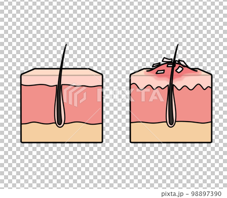 乾癬(図解)文字なし 乾癬(図解)文字なし 98897390