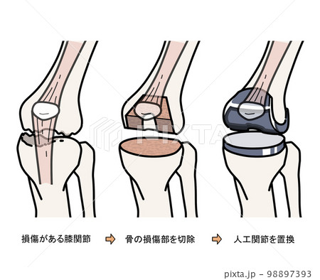 人工膝関節置換手術（TKA） 98897393