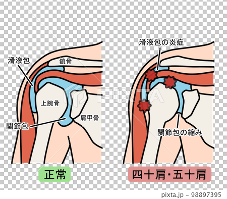 40肩/50肩 40肩/50肩 98897395