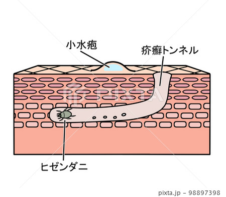 疥癬(文字あり) 疥癬(文字あり) 98897398
