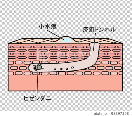 疥癬(文字あり) 疥癬(文字あり) 98897398