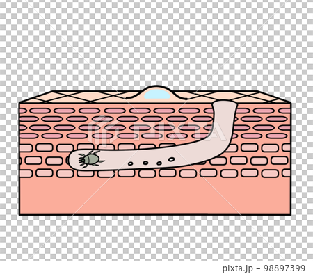 疥癬 疥癬 98897399