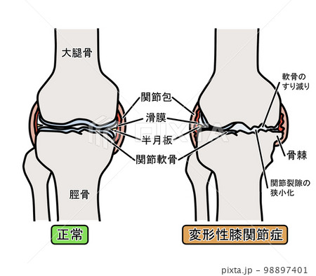 変形性膝関節症 98897401