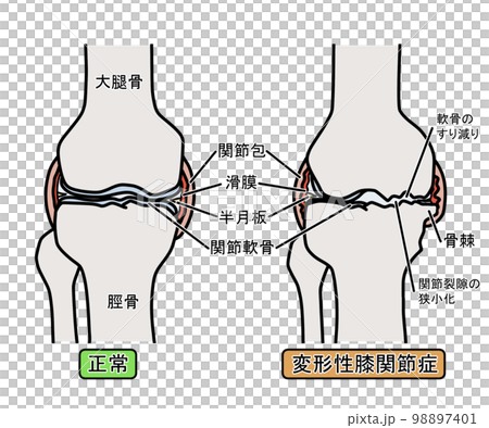 変形性膝関節症 98897401