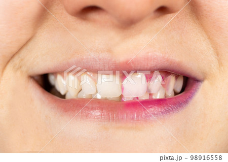 A woman's teeth before and after using indicator pills to determine plaque. A woman's teeth before and after using indicator pills to determine plaque. 98916558