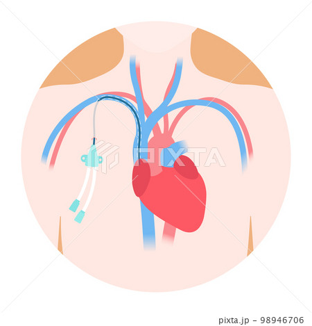 Tunneled central line venous catheter medical diagram Tunneled central line venous catheter medical diagram 98946706