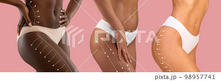 Millennial different women in bikini with slim body with lines for figure shaping or drainage massage and beauty therapy 98957741