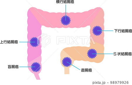 部位別の大腸がんの種類を図解 部位別の大腸がんの種類を図解 98979926