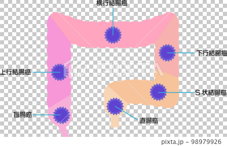 部位別の大腸がんの種類を図解 部位別の大腸がんの種類を図解 98979926