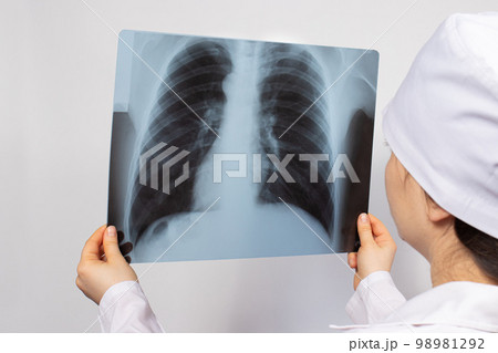 A doctor examines an X-ray of the lungs of a patient with pneumonia. Pulmonology and radiology, lung disease 98981292