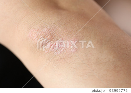 Damaged, dry itchy skin on elbow area close-up. 98993772