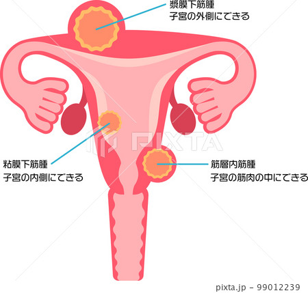 子宮筋腫の種類 99012239
