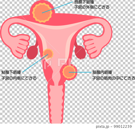 子宮筋腫の種類 99012239