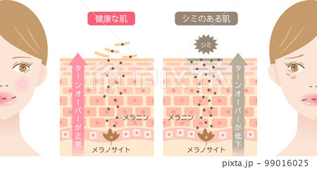 肌のシミとターンオーバー　肌細胞　女性　ビフォアアフター 99016025
