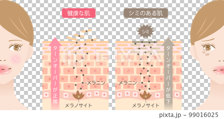 肌のシミとターンオーバー　肌細胞　女性　ビフォアアフター 99016025