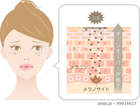 肌のシミ ターンオーバーと女性 断面図と細胞 肌のシミ ターンオーバーと女性 断面図と細胞 99016027