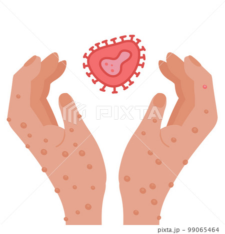 Hands with monkeypox rash holding virus cell. New virus outbreak pandemic design. Flat hand drawn vector illustration. Hands with monkeypox rash holding virus cell. New virus outbreak pandemic design. Flat hand drawn vector illustration. 99065464