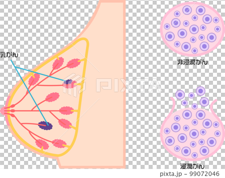 Illustrated illustration of breast cancer 99072046