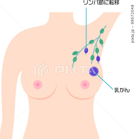 リンパ節に転移した乳がん 99072048