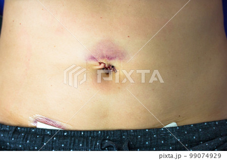 Woman's abdomen fresh medical scars after laparoscopy surgery, remove gallbladder, ovary, uterus, tumor. Wounds on woman's body, abdomen with band-aid. Belly button fresh stitches, hematoma, bruising. 99074929
