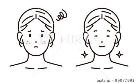 肌荒れ・ニキビに悩む女性と美肌の女性 99077993