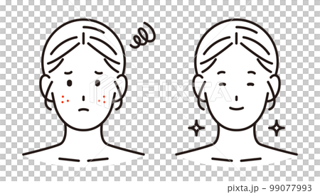 肌荒れ・ニキビに悩む女性と美肌の女性 99077993