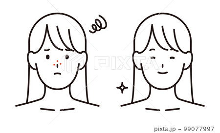 思春期ニキビに悩む女の子と美肌の女の子 99077997