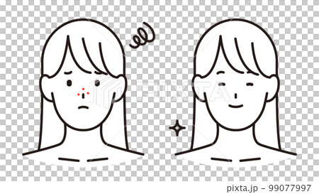 思春期ニキビに悩む女の子と美肌の女の子 99077997