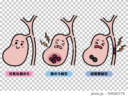 A set of healthy gallbladder, gallstones, and... - Stock Illustration ...