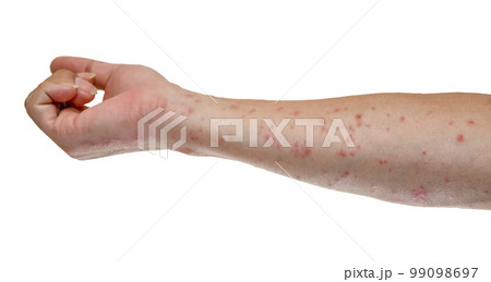 毛虫に刺されて赤く腫れる腕のアップ 99098697