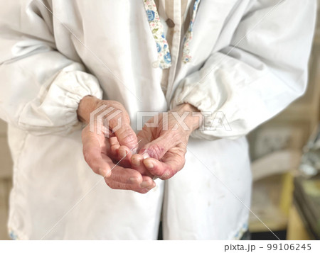 手荒れを気にする高齢女性 99106245