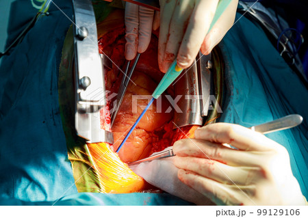 Disposable electrosurgical pencil incision on chest cutting during an operation in heart 99129106