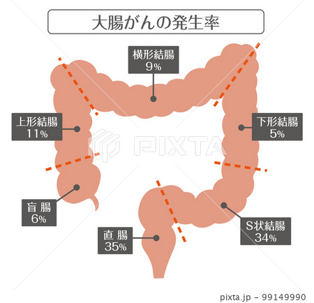 人間の体_大腸がんの発生率 99149990