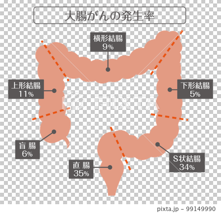 人間の体_大腸がんの発生率 99149990