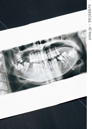 Panoramic picture of the jaw on black background 99168874