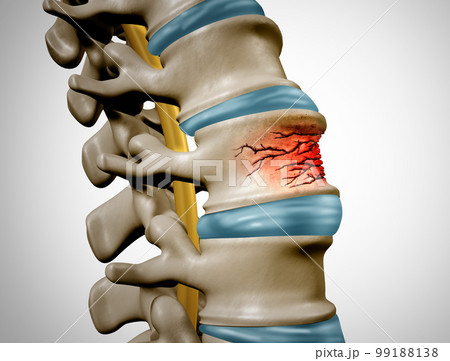 Traumatic Spine Fracture 99188138