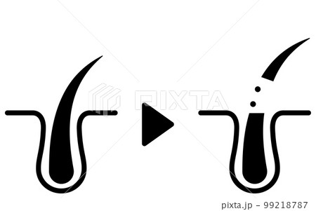 毛を剃った毛穴断面、脱毛・自己処理のイメージイラスト 毛を剃った毛穴断面、脱毛・自己処理のイメージイラスト 99218787