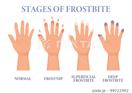 Frostbite stages. Frozen hands in different...のイラスト素材 ...